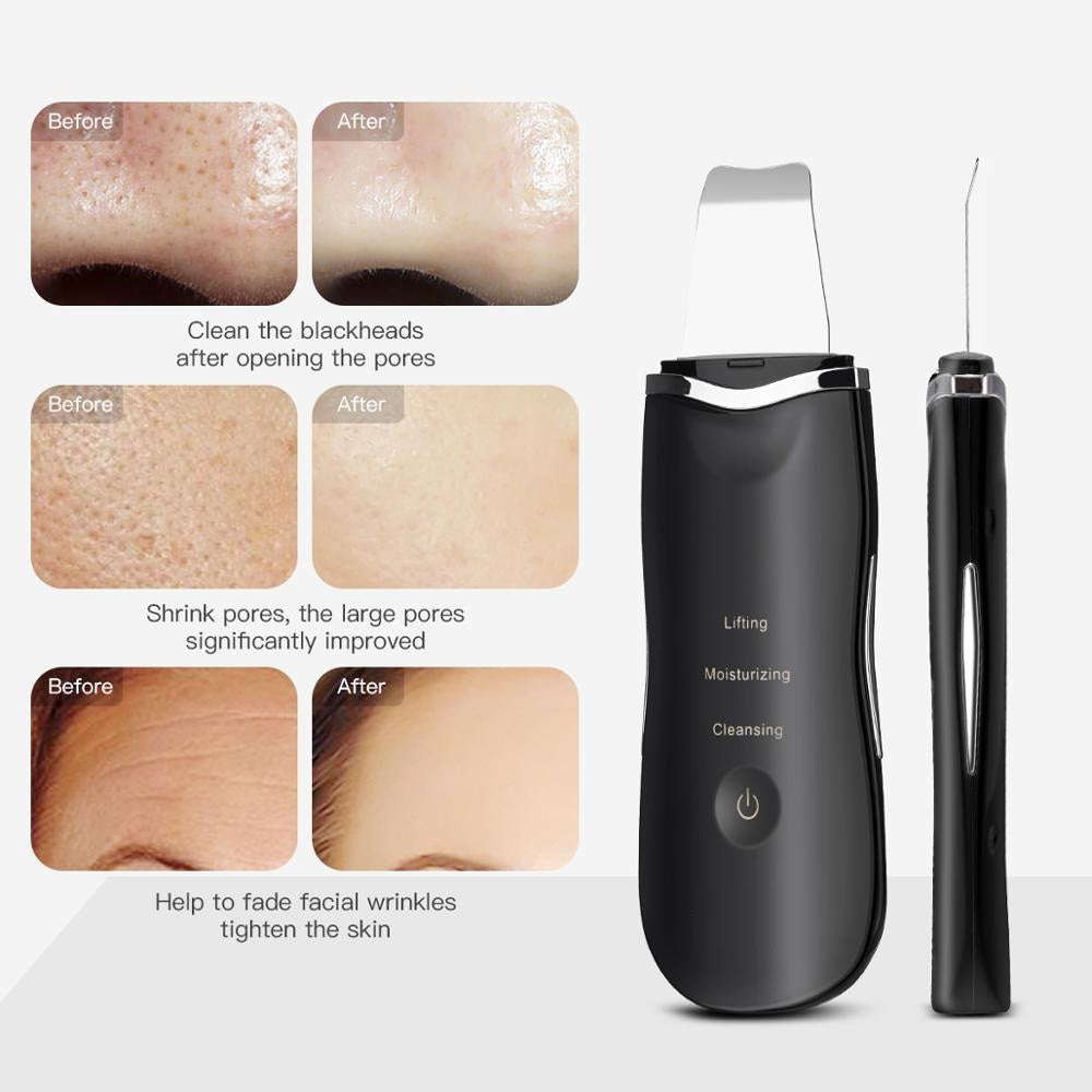 Professional  Ultrasonic Skin Spatula