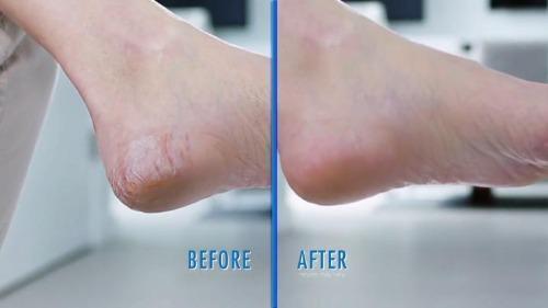 Electric Pedivac - remove your callus easily